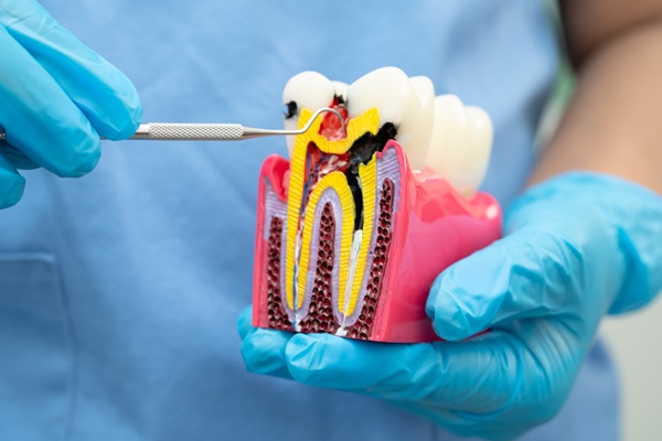 Why Do I Need A Crown After Root Canal Treatment?
