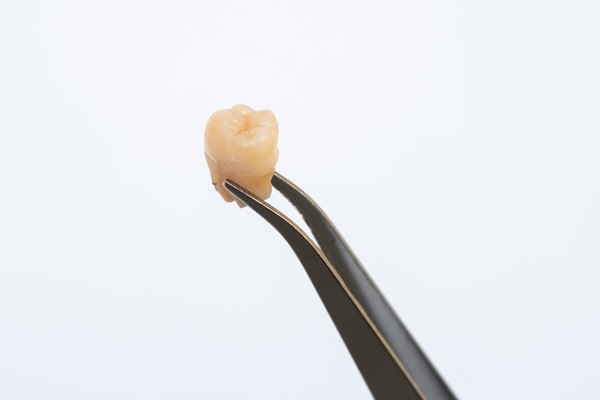 Wisdom Tooth Extraction: What To Expect And How To Prepare